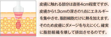 皮膚に触れる部分は直径4cm程度ですが、皮膚から1.3cmの深さの1点にエネルギーを集中させ、脂肪細胞だけに熱を加えます。そのため皮膚にダメージを与えにくく、確実に脂肪組織を壊して排出させるのです。